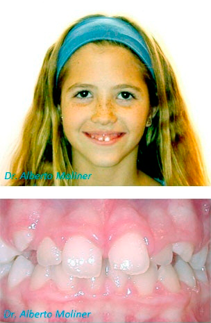 Antes - dientes